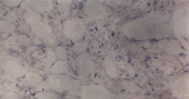 Figure 6: showing the symptoms of viral disease in the region of eye stalk by suspecting white spot syndrome virus in Macrobrachium rosenbergii.
