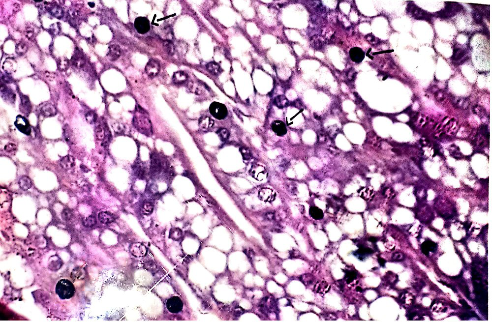 Figure 7: Showing the hypertrophic nuclear occlusion bodies in the tissue of gill region by suspecting white spot disease in Macrobrachium rosenbergii.