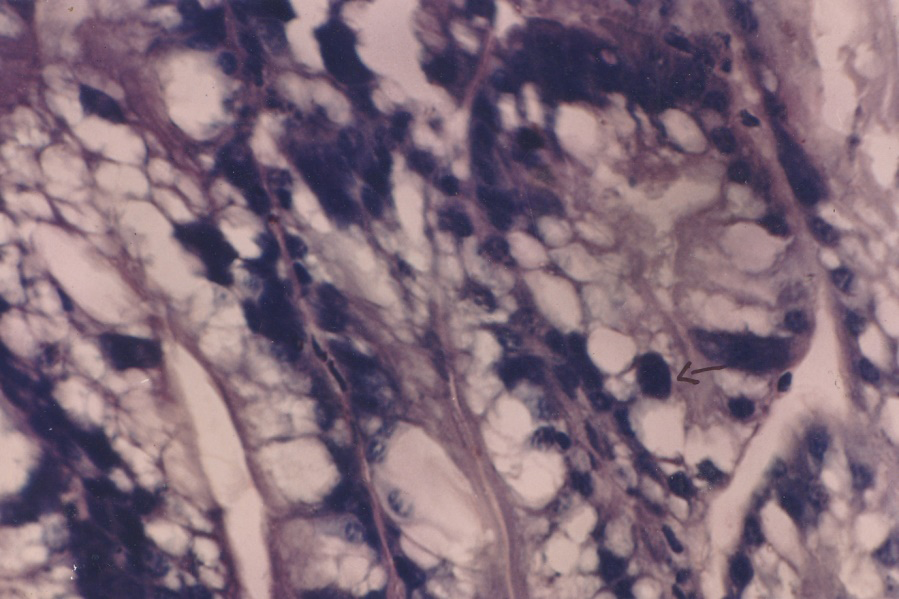 Figure 9: showing swollen head disease characterized by hypertrophic basophilic nuclear occlusion bodies in gill filaments in the prawn Macrobrachium rosenbergii.