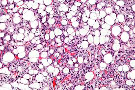 Figure 1: Dedifferentiated liposarcoma delineating abridged fascicles of spindle shaped cells intermingled with acute and chronic inflammatory cells and focal haemorrhage. Non lipogenic foci are intermixed with aggregates of mature adipose tissue cells [5].