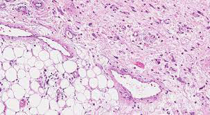 Figure 2: Dedifferentiated liposarcoma demonstrating a whirling pattern configured of short fascicles of spindle shaped cells commingled with acute and chronic inflammatory cells, patent capillaries and aggregates of mature adipose tissue cells [6].