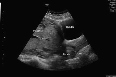 Figure 10: Ultrasound image of type 2 placenta previa. Source: Fox, et al. Prenatal Diagnosis and Evaluation of Abnormal Placentation. Clinical Obstetrics and Gynecology. 60: 596-607. 10.1097/GRF.0000000000000297.