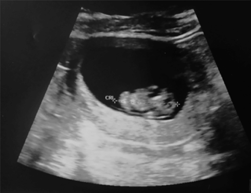Figure 5: Ultrasound Image shows the ultrasound scan performed at 10 weeks of gestation. Source: Sciorio, et al. Case report One follicle, one egg, one embryo: a case-report of successful pregnancy obtained from a single oocyte collected, JBRA assisted reproduction. 25. 10.5935/1518-0557.20200087.