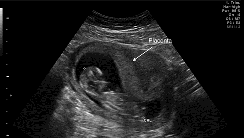 Figure 7: Ultrasound of the placenta at 27 weeks of gestational age. Source: Ismail KI, et al. Role of 2-Dimensional Ultrasound Imaging in Placental and Umbilical Cord Morphometry: Literature and Pictorial Review. J Ultrasound Med, 38: 3131-3140. https://doi.org/10.1002/jum.15024