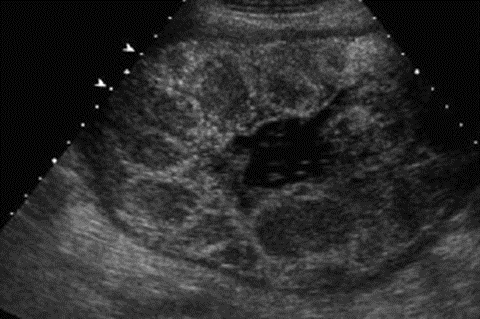 Figure 8: Ultrasound imaging of the Placenta at 35 weeks gestational age. Source: Ozcan T, et al. Pressman, Imaging of the Placenta, Ultrasound Clinics, Volume 3, Issue 1, 2008, Pages 13-22, ISSN 1556-858X, https://doi.org/10.1016/j. cult.2007.12.007. (https://www.sciencedirect.com/ science/article/pii/S1556858X07001429) Developmental changes in the placenta during gestation can be related to the growth and development of the fetus as earlier stated. These changes occur in three major anatomical regions: the amnion chorion plate, the placental body, and the basal layers [13]. Most importantly during maturation in the third trimester, the placenta develops calcifications which is of high significance in a process known as placental grading which is a test of fetal wellbeing (Figure 4).