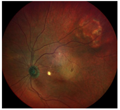 Figure 1: Fundus photographs of the right eye.