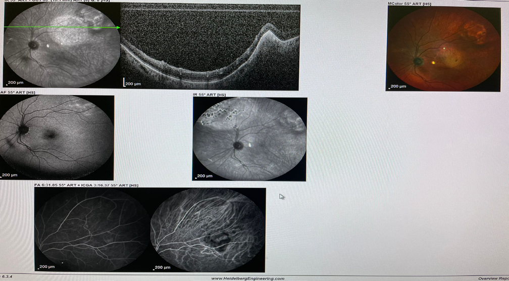Figure 10: Fluorescein angiography and Indocyanine green angiography of the left eye.
