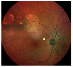 Figure 2: Fundus photographs of the left eye.