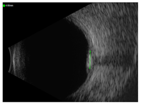 Figure 4: B-scan ultrasound.