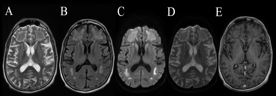 Figure 1: Bilateral symmetrical T2 (A) and FLAIR (B) hyperintense signals in deep white matter of frontoparietal and occipital regions with sparing of gray matter. Similar areas show diffusion restriction with corresponding drop in ADC signals (C,D). Mild contrast enhancement is visible in bilateral frontal areas (E).