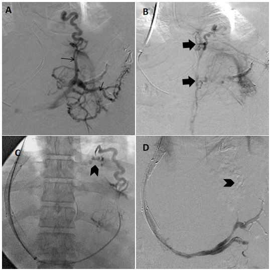 Figure 2: A patient with active variceal bleeding with endoscopy suggestive of large type 2 gastroesophageal varices (GOV- 2). A) Antegrade splenoportogram showed the predominant afferent supply of the gastric varices in the cardio-fundal region (GOV-2) to be arising from the short gastric vein (SGV). Also multiple smaller afferent branches were seen arising directly from the splenic vein with formation of varices in the body and pylorus of stomach suggestive of type 2 isolated gastric varices (IGV-2) (arrow). The presence of IGV-2 suggests sinistral portal hypertension as the etiology. However, no evidence of portal vein thrombosis was seen. B) Delayed portography images show absence of catheterizable shunt with efferent drainage of the varices (GOV-2 and IGV-2) via left inferior phrenic vein and small direct branches into IVC. (Block arrows) A type D efferent anatomy makes retrograde obliteration of varices not feasible in this case. C) Post TIPS placement splenoportogram showed persistent opacification of the GOV-2 varices. Note the active extravasation of contrast agent seen from the GOV-2 varices (arrowhead). D) No contrast opacification of gastric varices was seen on the splenoportography images after glue injection and TIPS placement. Glue cast is seen in the SGV. [TIPS = Transjugular Intrahepatic Portosystemic Shunt].