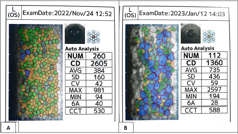 Figure 2: A) LE preoperative specular microscopy. B) Specular microscopy 6 weeks after ICL implantation in LE.