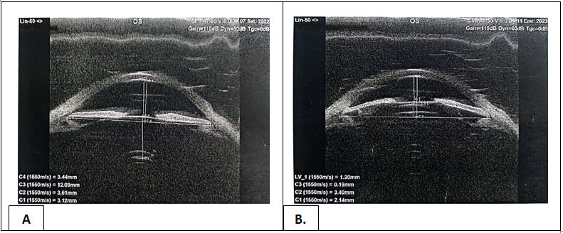 Figure 3: A) LE preoperative UBM. B) UBM 6 weeks after ICL implantation in LE.