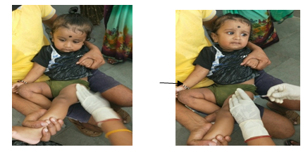 Figure 7: Child during intramuscular vaccination by using helfer skin tap technique.