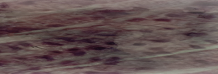 Figure 4: Showing the Gill Filament Infected with Hypertrophic Nuclear Basophilic Occlusion by Suspecting WSSV in the Prawn Penaeus monodon.