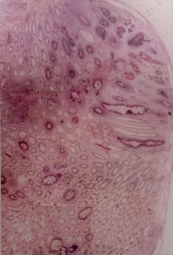 Figure 7: Showing the Hepatopancreas Necrosis by Bacterial Disease in the Tiger Prawn Penaeus monodon.