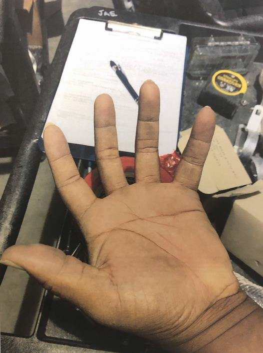 Figure 13: The Photograph Taken of the Claimant’s Hand after the Incident Showed no Signs of Injury.