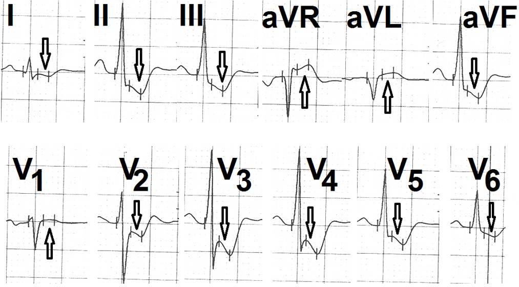 Figure 5: Leads II, III, aVF, V4, V5 and V6 showing downsloping ST-segment depression of less than 2 mm (marked as ↓).