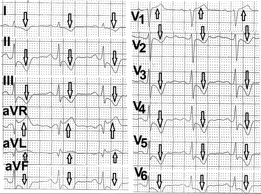 Figure 8: Electrocardiogram recorded at the end of fifth minute of recovery from the same patient as in figure 7 showing heart rate of 76 beats per minute. ST-segment changes are similar to figure 7.