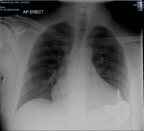 Figure 1: CXR on admission.
