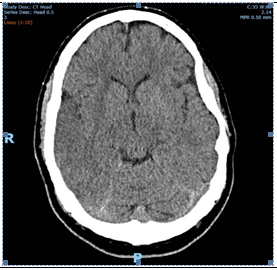 Figure 2: Axial CT-B on day 1; early ischaemic changes in the right MCA territory (edema).