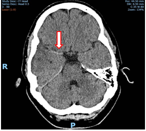 Figure 3: Axial CT-B on day 1; hyperdensity in the right MCA course.