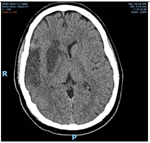 Figure 6: Axial CT-B on day 3; maturation of infarct.