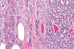 Figure 2: Pancreatic neuroendocrine tumour exhibiting ribbons, nests, cords, glands and pseudo-acinar structures of neuroendocrine cells imbued with moderate eosinophilic cytoplasm, nuclei with finely stippled nuclear chromatin and indistinct nucleoli. Surrounding stroma is vascularized [5].