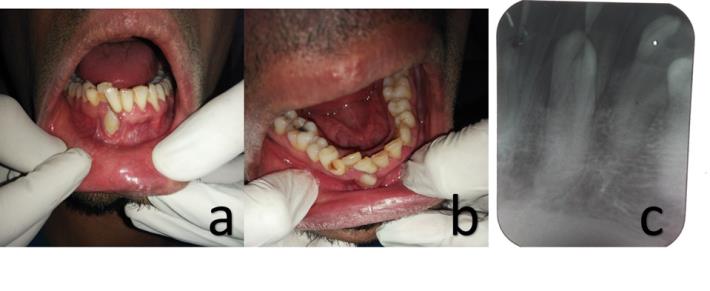 Figure 1: A: Ectopic eruption of right mandibular canine; B: Retained deciduous mandibular canine; C: Intra oral periapical radiograph revealing complete apexification of right mandibular canine.
