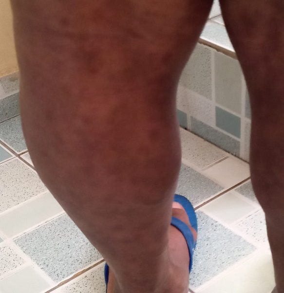 Figure 2: No dermatological reactions five months after administration of the second dose of the vaccine.