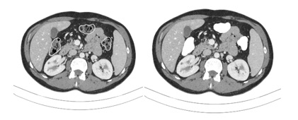 Figure 1: Manual segmentation and image density change of the colon surface in CT slices.