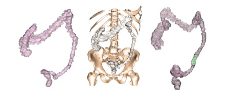 Figure 2: 3D reconstruction image of the colon and location of the tumor with color change.