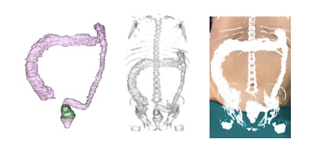 Figure 4: Real projection of the hologram on the patient`s abdomen placed in the operating room.