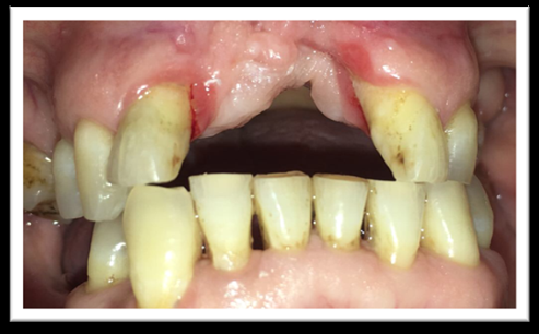 Figure 1: Female patient 72 years old. Diagnosis of Osteoporosis. Consume Ibandronate 150 mg/ every 30 days, for 6 years. Bimaxillary edentulous. Upper full denture wearer. Presence of decubitus ulceration with bone exposure, no suppuration, no pain.