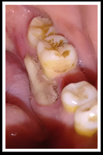 Figure 3: Female patient 75 years old. Osteoporosis.