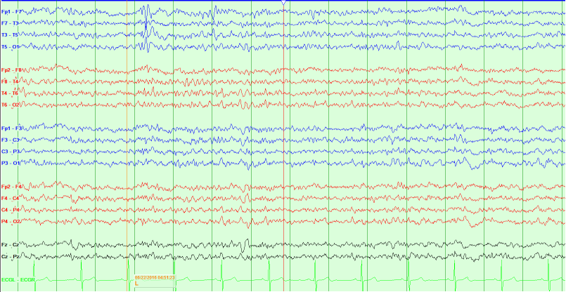 Figure 1: EEG: showing occasional temporal sharp waves.