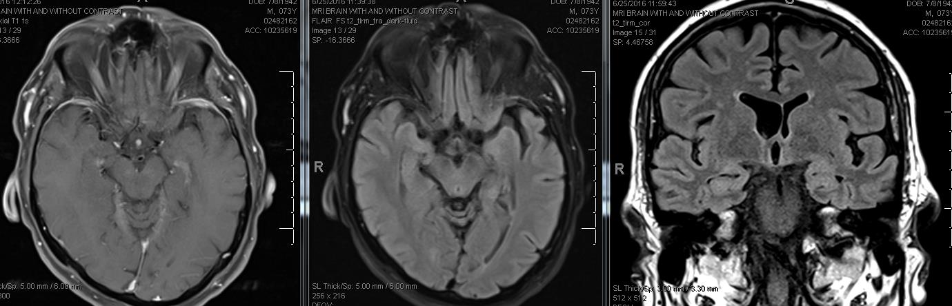 Figure 2: MRI of the brain in axial and coronal sections (A) axial T1 with contrast, (B) axial Flair without contrast and (C) Coronal thin cuts through temporal lobes.