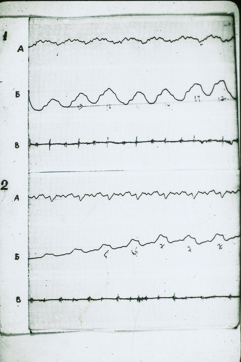 Figure 2: Rheogram of pulsatory blood flow of the same patient. The designations are the same.