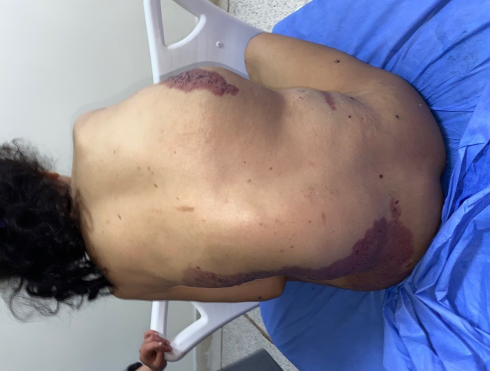 Figure 2: Lipomatous mass of the back, in front of which there is also an angiomatous placard, with evident scoliosis.