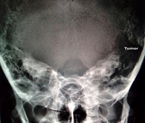 Figure 1: Plain radiography of skull showing irregular lytic area at left petro-mastoid region.