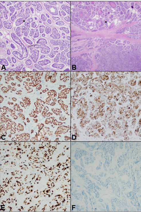 Figure 1: The biopsy and resection specimens from patient 1 demonstrated anastomosing islands of basaloid cells with peripheral palisading, stromal clefting, and desmoplastic stroma (marked with asterisk) on hematoxylin and eosin (H&E) staining (A). Focal high-grade features were noted including comedonecrosis and de-differentiation with sheet-like growth and marked pleomorphism, marked with asterisk (B). Lesional cells exhibited a staining pattern that supported basal cell carcinoma – strong nuclear positivity with p63 (C), cytoplasmic and membranous staining with BCL2 (D), markedly elevated proliferation index with Ki-67 (E), and negative PSA (F).