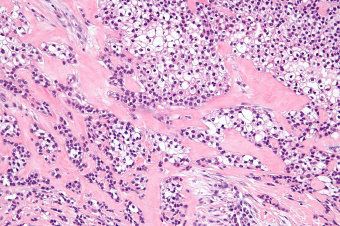 Figure 1: Hyalinising clear cell carcinoma demonstrating cords, nests and trabeculae of tumour cells imbued with clear cytoplasm surrounded by hypo-cellular, dense, hyalinised stroma juxtaposed with myxoid and desmoplastic stroma [7].