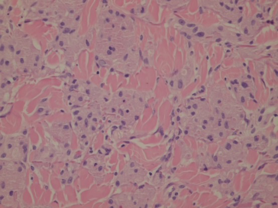 Figure 3: Immunohistochemistry S 100.