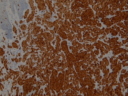 Figure 4: Immunohistochemistry Cd 68.