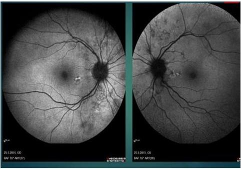 Figure 1: Nasal retinal degeneration on FAF.