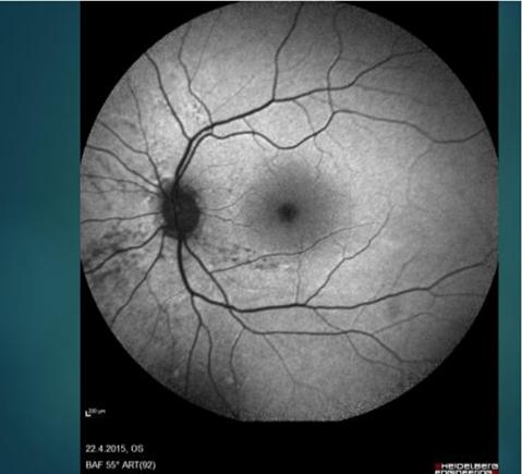 Figure 2: Nasal neurodegeneration on FAF. In 14 R- handed patients who had early PD, degenerative lesions were on then as al side. 1 L- handed patient had changes in the temporal retina (Figure 3). None of the R- handed patients had neurodegeneration on the temporal side. Diffuse degeneration on FAF was detected in the middle –late stages of the disease. 4patients had this kind of distribution. The early asymmetric appearance was in parallel with the asymmetric findings in motor functions. The possibility to detect hemi-retinal neurodegeneration in patients with unilateral motor findings was statistically significant (P: 0,00).