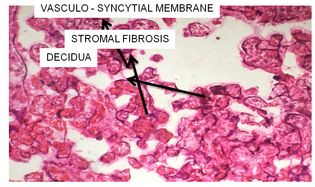 Figure 6: Slide of Placenta showing Stromal Fibrosis.