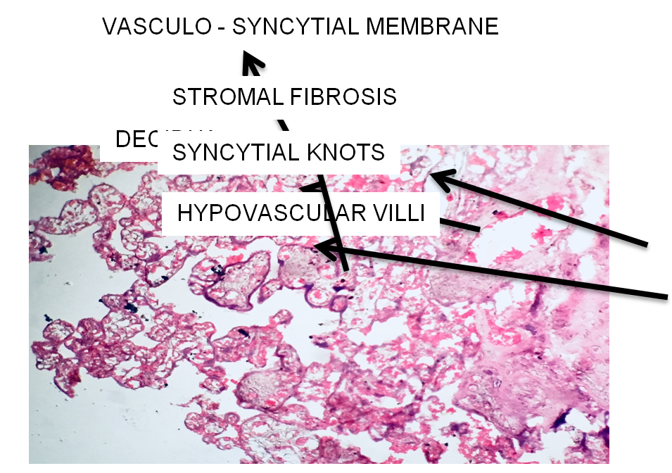 Figure 8: Slide of Placenta showing multiple Hypovascular Villi.