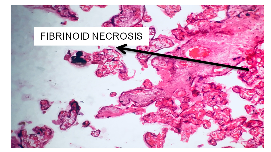 Figure 9: Slide of Placenta showing Fibrinoid Necrosis.