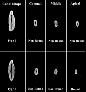 Figure 3: Representative image of other root canal variations seen in permanent mandibular central and lateral incisors evaluated in current study according to Gulabivala’s classification and possibly a “C-shaped” as the longitudinal section resembles 2 canals and the cross- section images at coronal, middle and apical third resemble a c shaped with a developmental groove as seen with teeth exhibiting this root canal anatomy (white arrows).